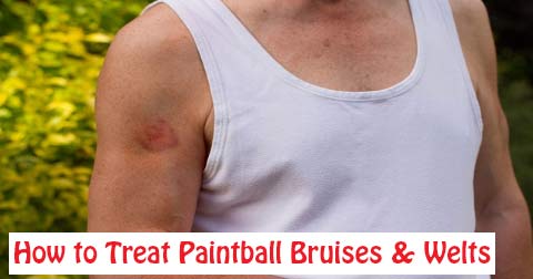 How to Treat Paintball Bruises and Welts to Heal Faster